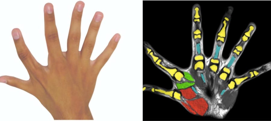 6本指を持つ人に「+αの脳領域」の存在を確認