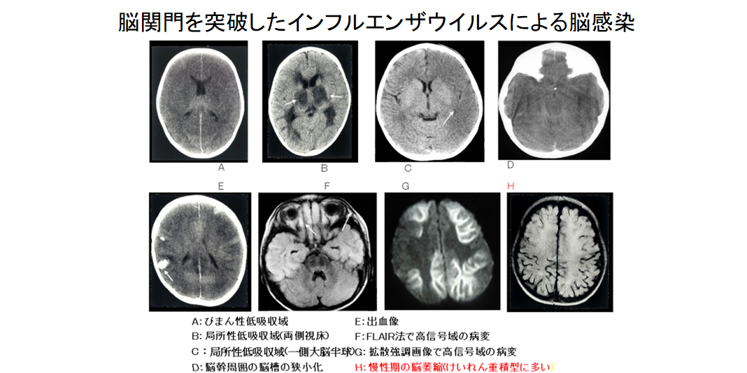 新型コロナウイルスが脳に大きな後遺症を与える可能性の画像 5/6