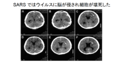 新型コロナウイルスが脳に大きな後遺症を与える可能性の画像 4/6