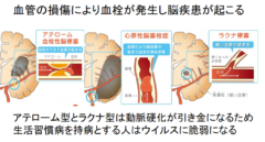 新型コロナウイルスが脳に大きな後遺症を与える可能性の画像 3/6