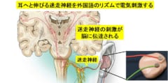 耳につけるだけで、外国語のリスニング能力が2倍になるウソみたいな装置。耳から「脳神経」を刺激するの画像 1/3