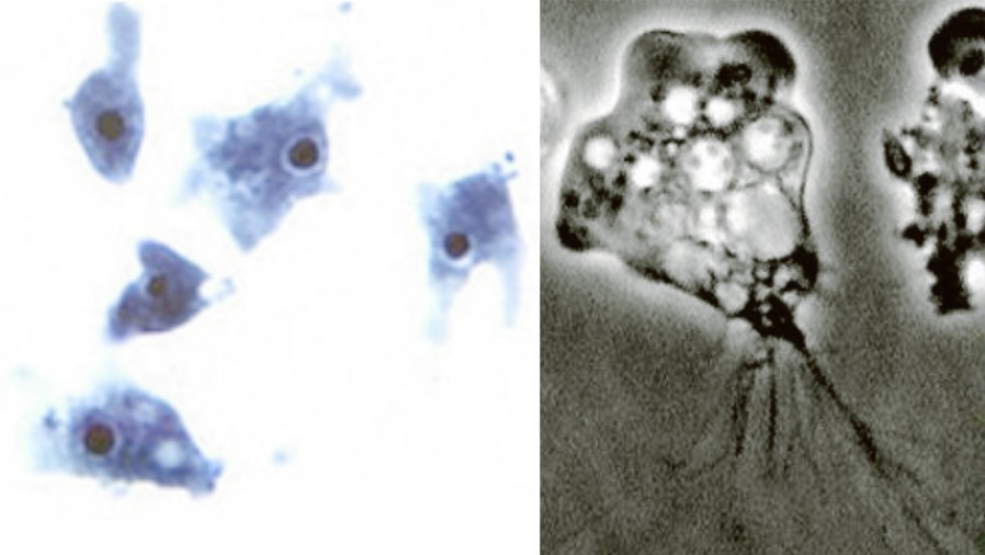 脳を溶かす「殺人アメーバ」に6歳の児童が感染し死亡、感染経路は鼻に入った”自宅の水道水”!?