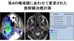 これまで唾液腺周辺の放射線治療はどんなに努力しても口の渇きを誘発する場合があった。新しい臓器である第4の唾液腺の存在が明らかになった今、放射線の照射経路を再構築する必要がある