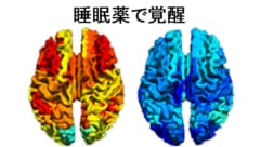 重度の脳障害を負った男性が睡眠薬で覚醒状態になる