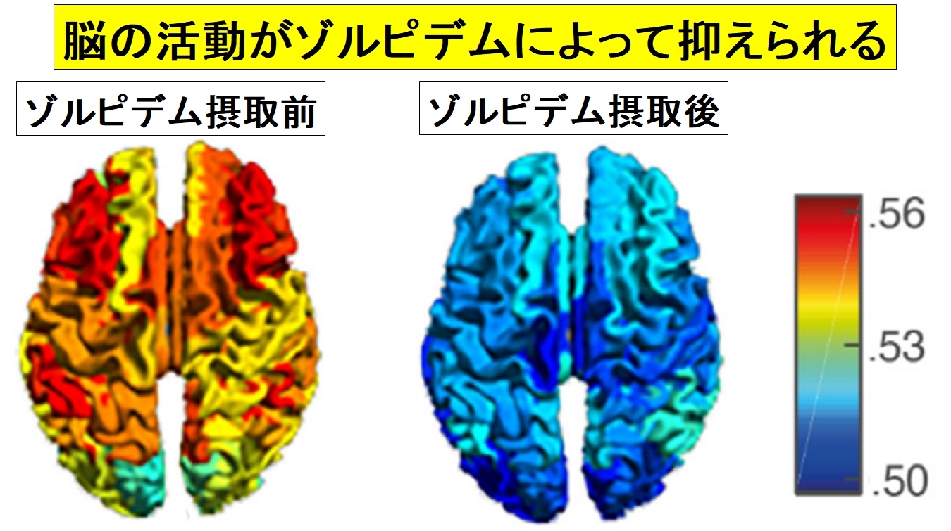 脳の過活動を抑制することで無動無言の症状が回復した