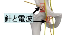 患部に針を挿入し電波を照射して加熱する