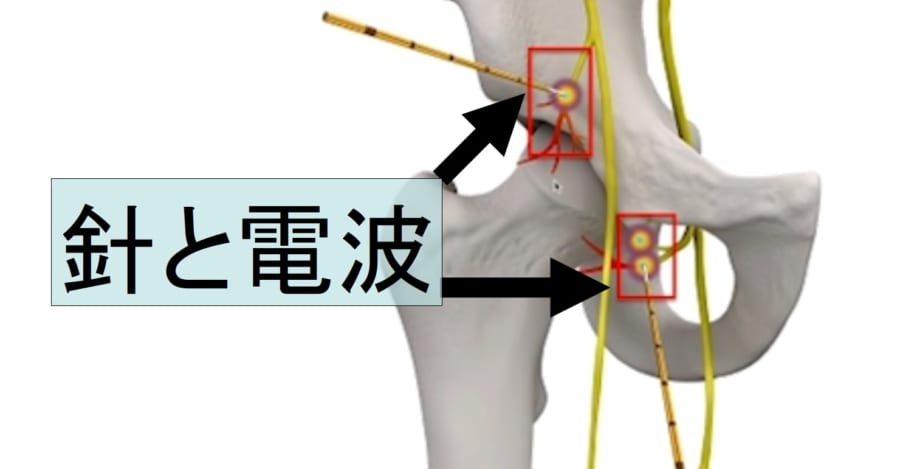 「電波」で関節痛を取り去る方法が発表される！