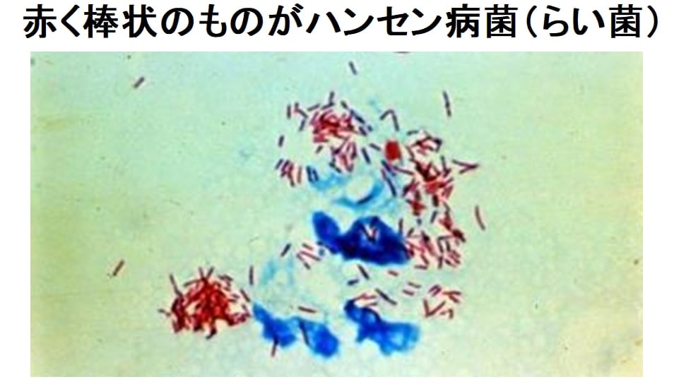 ハンセン病菌にとって人間やチンパンジーへの感染はあまり重要ではないのかもしれない