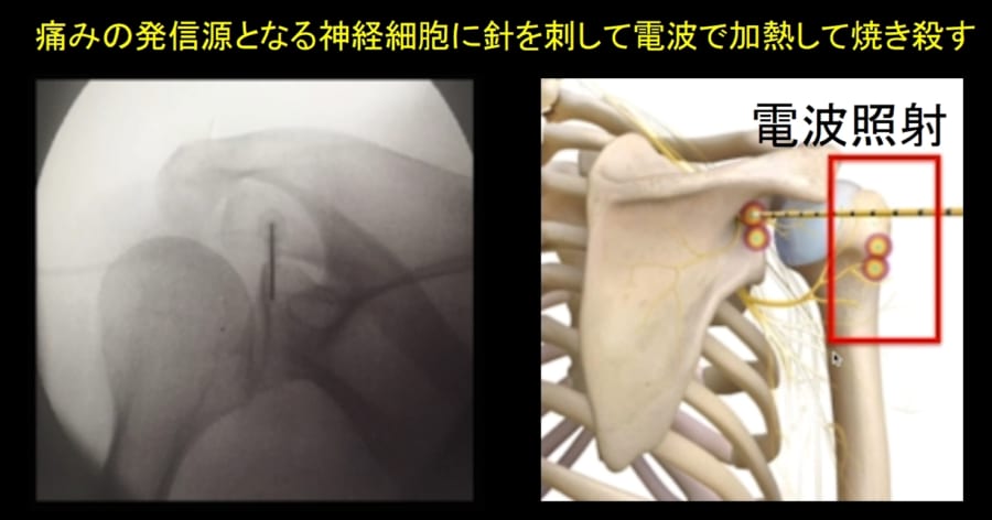 体の自由を保ったまま痛みを発する神経だけを焼き殺す