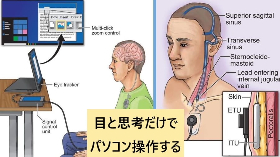 “思考でパソコンを操作可能”にする脳インプラントが登場！