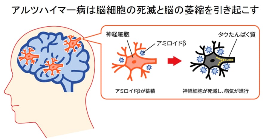 アルツハイマー病は脳内にアミロイドベータが蓄積する病気