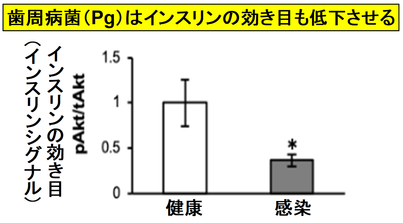 歯周病菌はインスリンの効き目も落とす