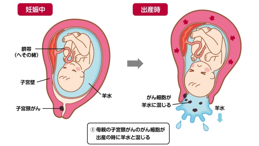 「母親の子宮頸がんが子どもの肺にうつる」症例を確認、羊水に混ざったがん細胞を飲み込んでいた