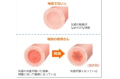 喘息による気道の状態。