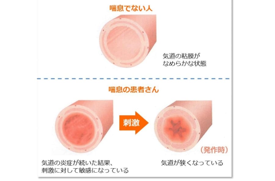 喘息による気道の状態。