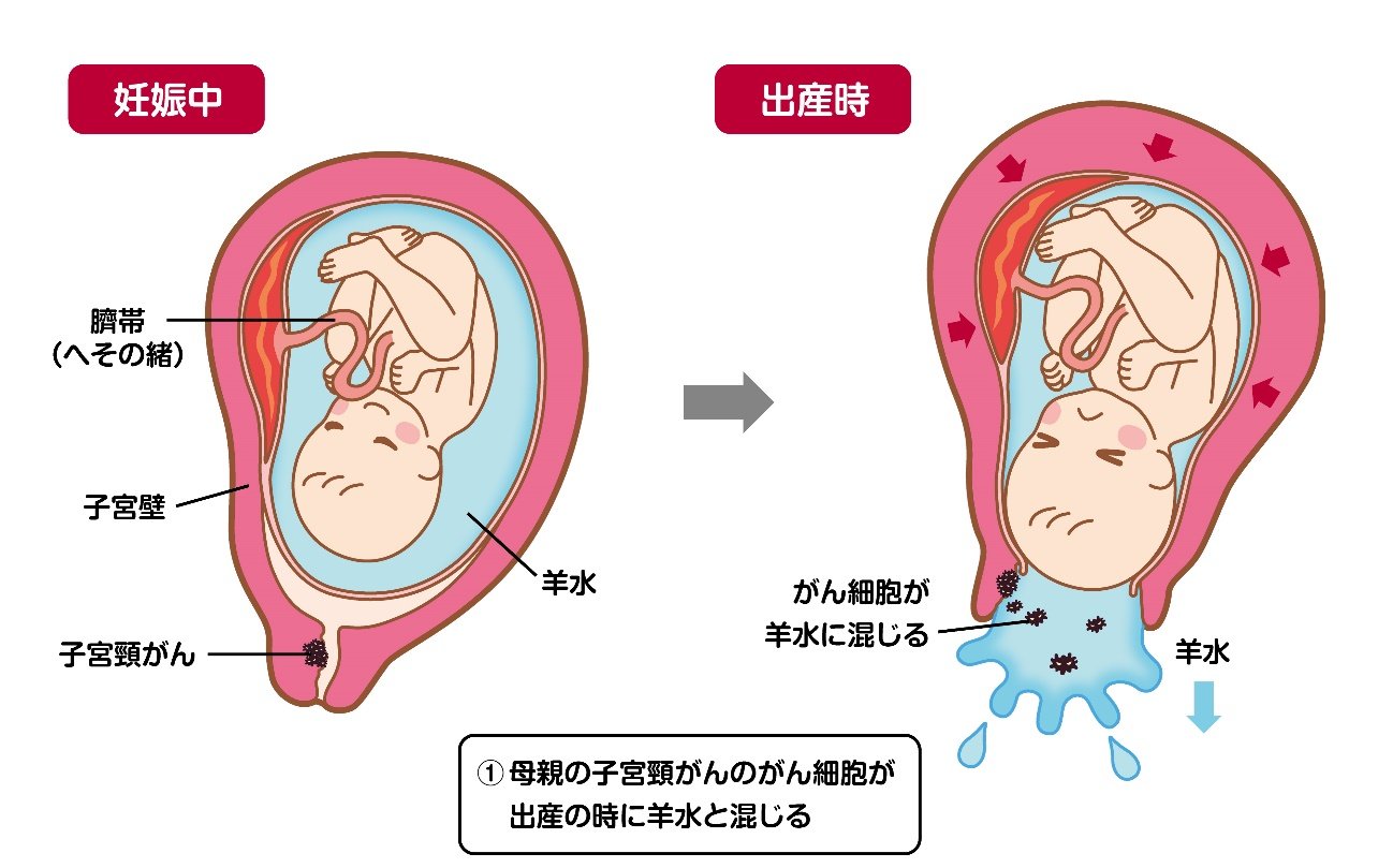 母から子どもの肺へのがん細胞移行