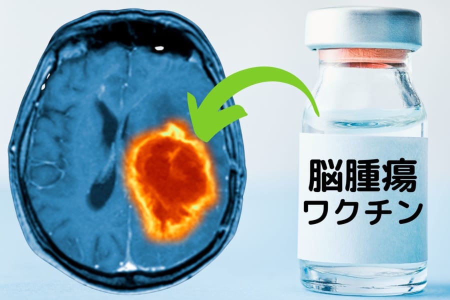 脳腫瘍を「ワクチン」で治療することに成功　人間への治験を実施中