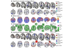 プラセボ効果は複数の脳領域で痛みを軽減させていた
