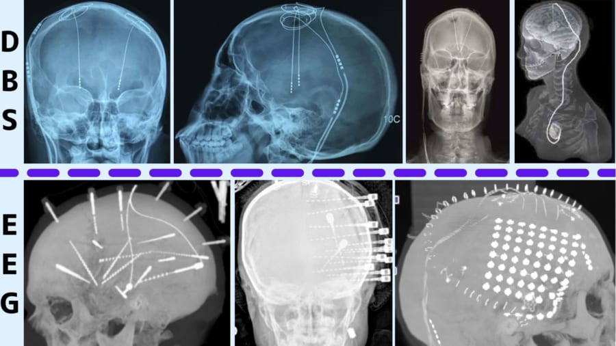 上段が代表的な脳深部刺激療法（DBS）で下段が前回の研究の基礎となったステレオEEG技術。単純な抑制を目的にしたDBSはEEGにくらべて簡素な電極が用いられているのがわかる。
