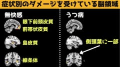 無快感症の人は快感に関連する脳領域にダメージを受けている