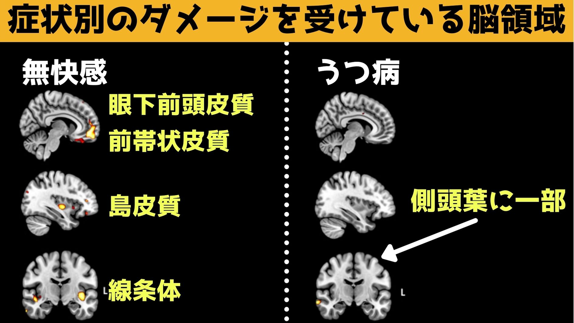 無快感症の人は快感に関連する脳領域にダメージを受けている