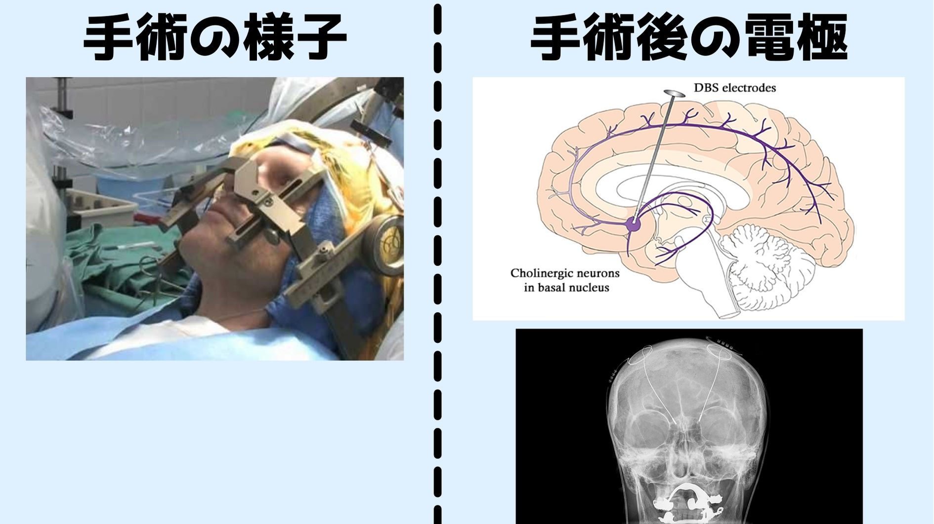 代表的なDBS手術の概要：今回の研究では患者たちは5人中3人が意識がある状態で手術が行われた