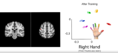 指の神経表現に関する脳の活動が萎縮していた