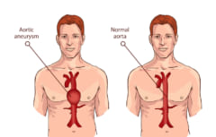 胸部大動脈瘤のイメージ