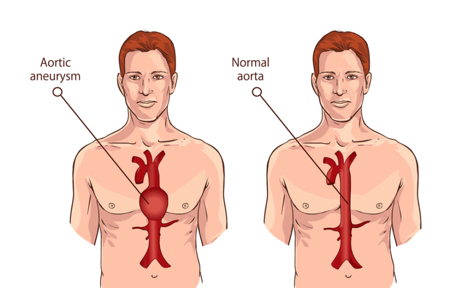 胸部大動脈瘤のイメージ