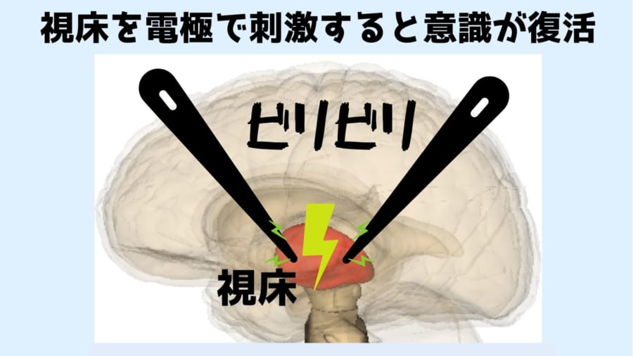 視床を大出力の電気で刺激すると麻酔中にもかかわらず目覚めることができる