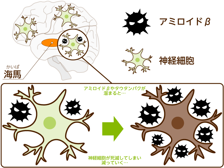 アミロイドβの蓄積がアルツハイマー病の原因となっている