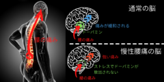 慢性腰痛症はストレスで痛みのブレーキが効かないために起きる