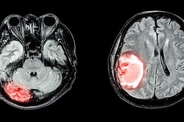 「尿検査」から99％の精度で脳腫瘍を判定可能に