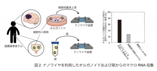 尿検査で脳腫瘍を発見する方法