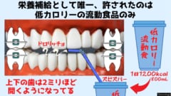 磁石で口を「物理的にロック」する減量装置が開発されるの画像 4/8