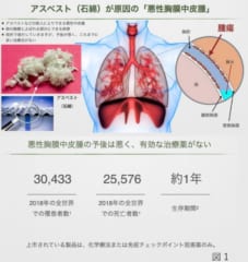 悪性胸膜中皮腫の発症と予後