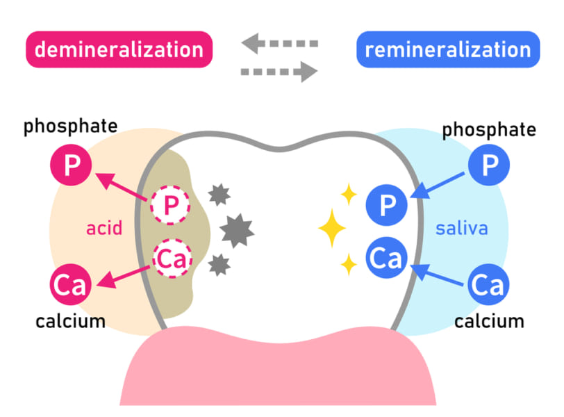 エナメル質の脱灰と再石灰化