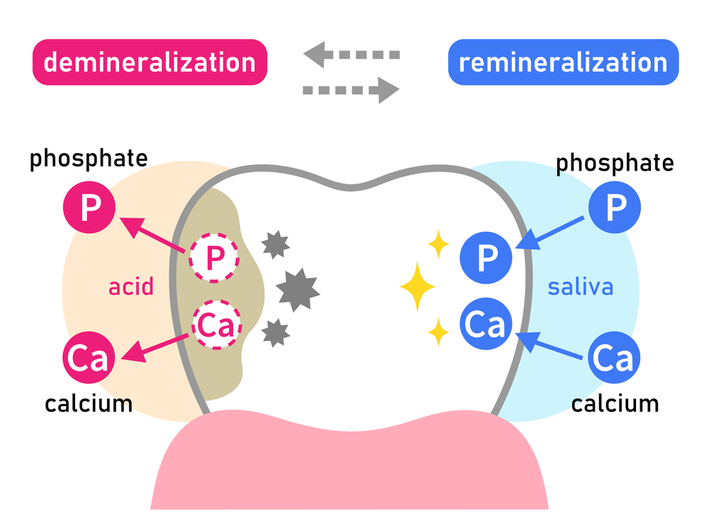 エナメル質の脱灰と再石灰化