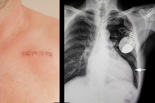 ペースメーカーは皮下への植込み手術で設置される
