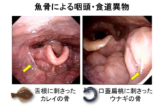 魚骨異物の疾患例