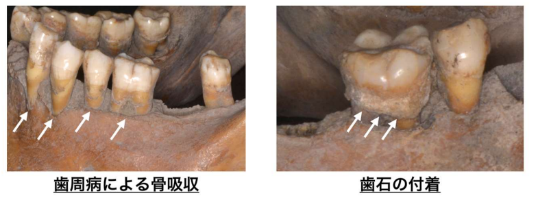 江戸時代人の歯に見られる歯周病の証拠