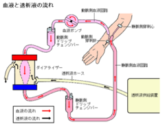 血液透析の仕組み