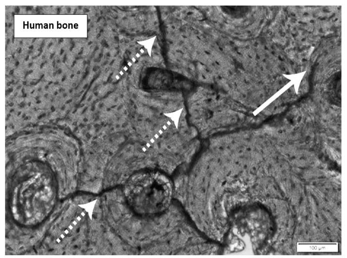 人間の骨に雷レベルの電流を流した際に残る、独特の亀裂パターン