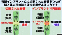 脊髄インプラントの内部にある神経ネットワークが脊髄の神経と接続した結果、前後の神経の再接続がなされました