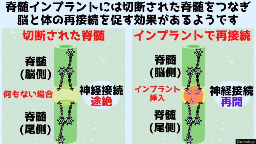 脊髄インプラントの内部にある神経ネットワークが脊髄の神経と接続した結果、前後の神経の再接続がなされました