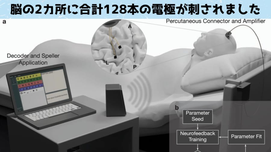 難病で「脳に閉じ込められた男性」、脳インプラントで家族との会話に成功