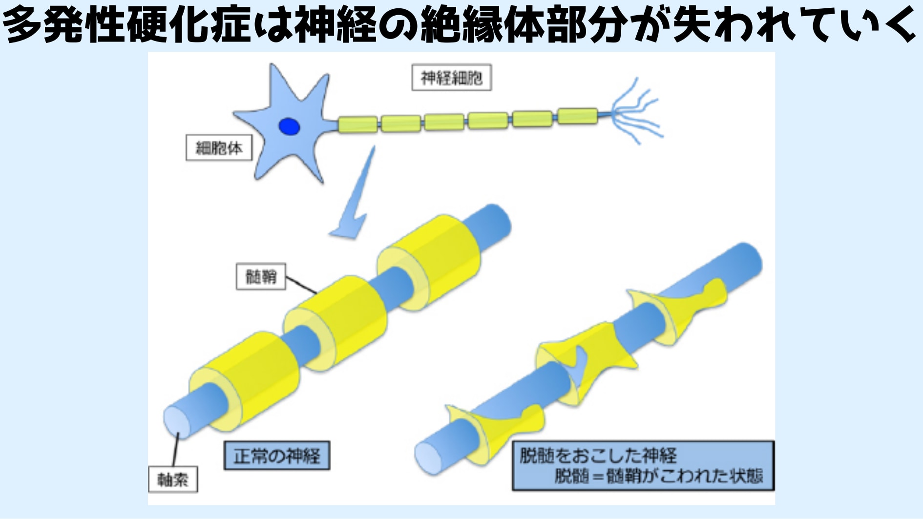 多発性硬化症では神経の絶縁体が失われていく