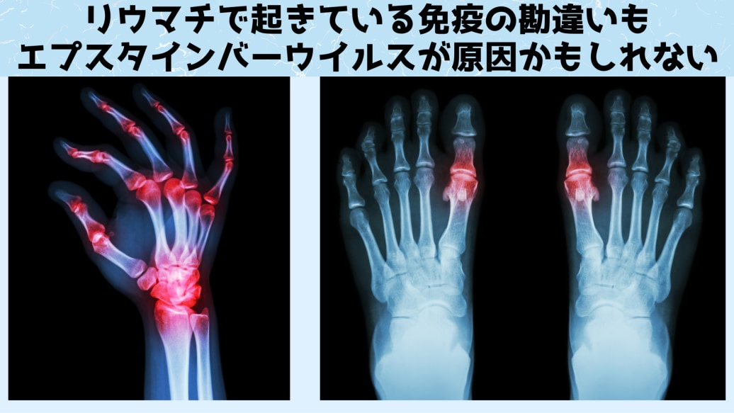 EBウイルスは関節リウマチにも関与している