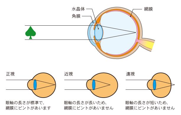 眼軸が長くなると近視になる