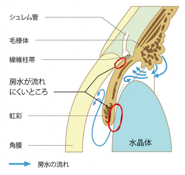 「原発閉塞隅角緑内障」の仕組み